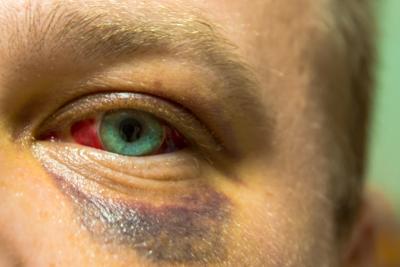 Protective eyewear may prevent 90 percent of sports-related eye injuries