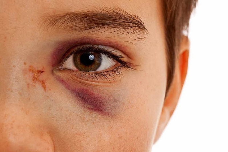 eye injuries